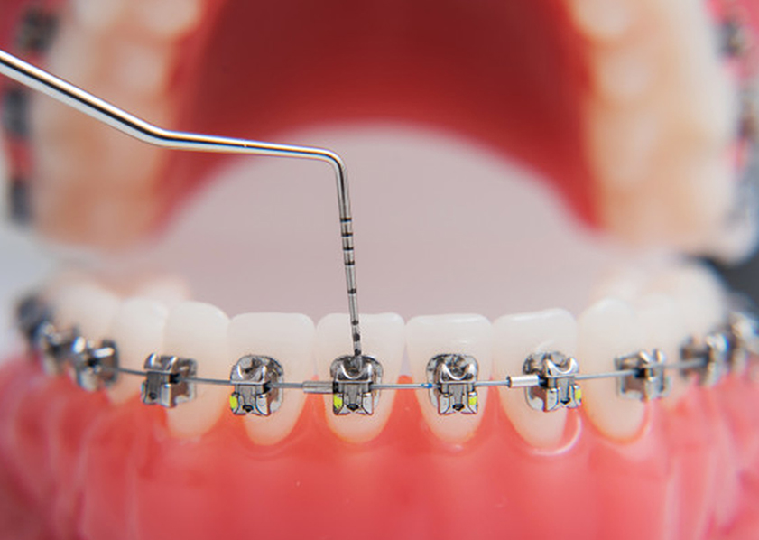 Straight Wire Orthodontic Bracket and Wire Example