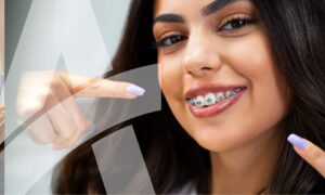 Straight wire braces vs. clear aligners